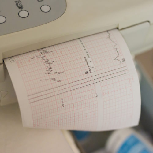 Fetal monitoring during labour My BabyManual