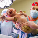Baby being delivered by C-section