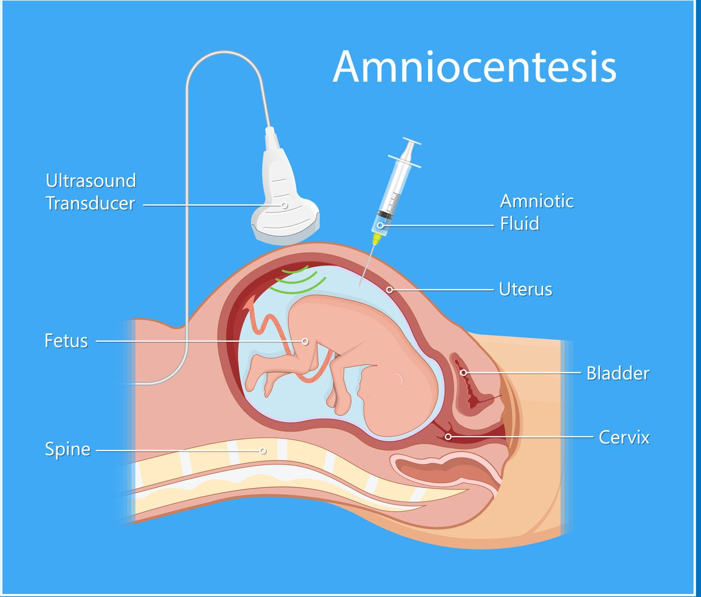 Invasive testing amniocentesis